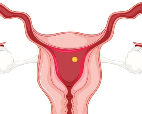Polycystic ovary syndrome and Common Questions About it?