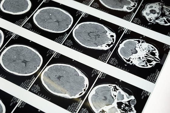 multiple sclerosis MS